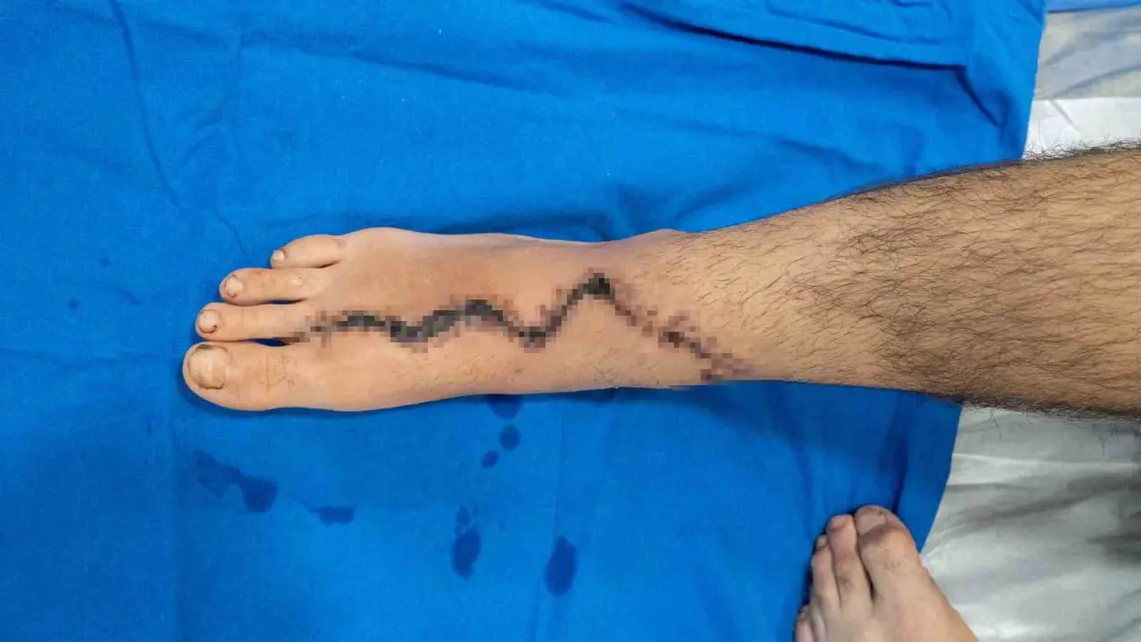 Parmaklarını kıyma makinesine kaptıran 13 yaşındaki çocuğa ayağından nakil