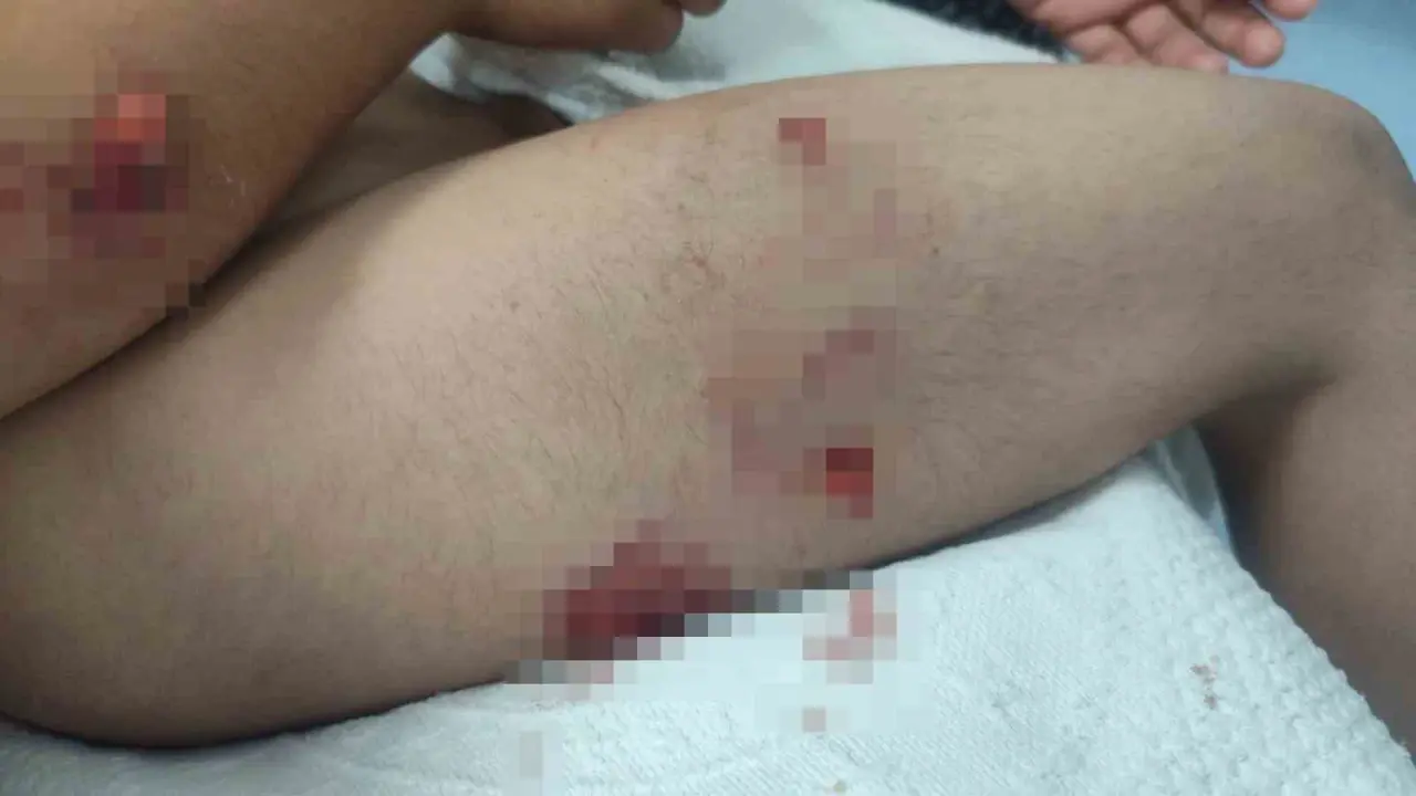 Köpek saldırısına uğrayan çocuğun başına 15 dikiş atıldı