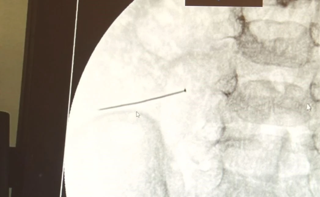 Ağrıyla kıvranan 2 yaşındaki çocuğun bağırsağından 3 santimlik iğne çıktı
