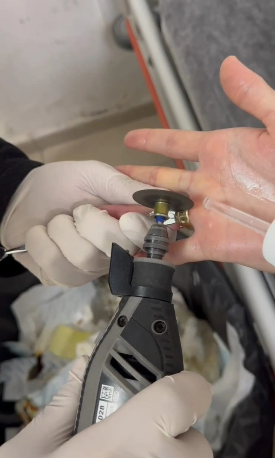 Batman’da parmağa sıkışan iki yüzük ’spiral makine’ ile çıkarıldı
