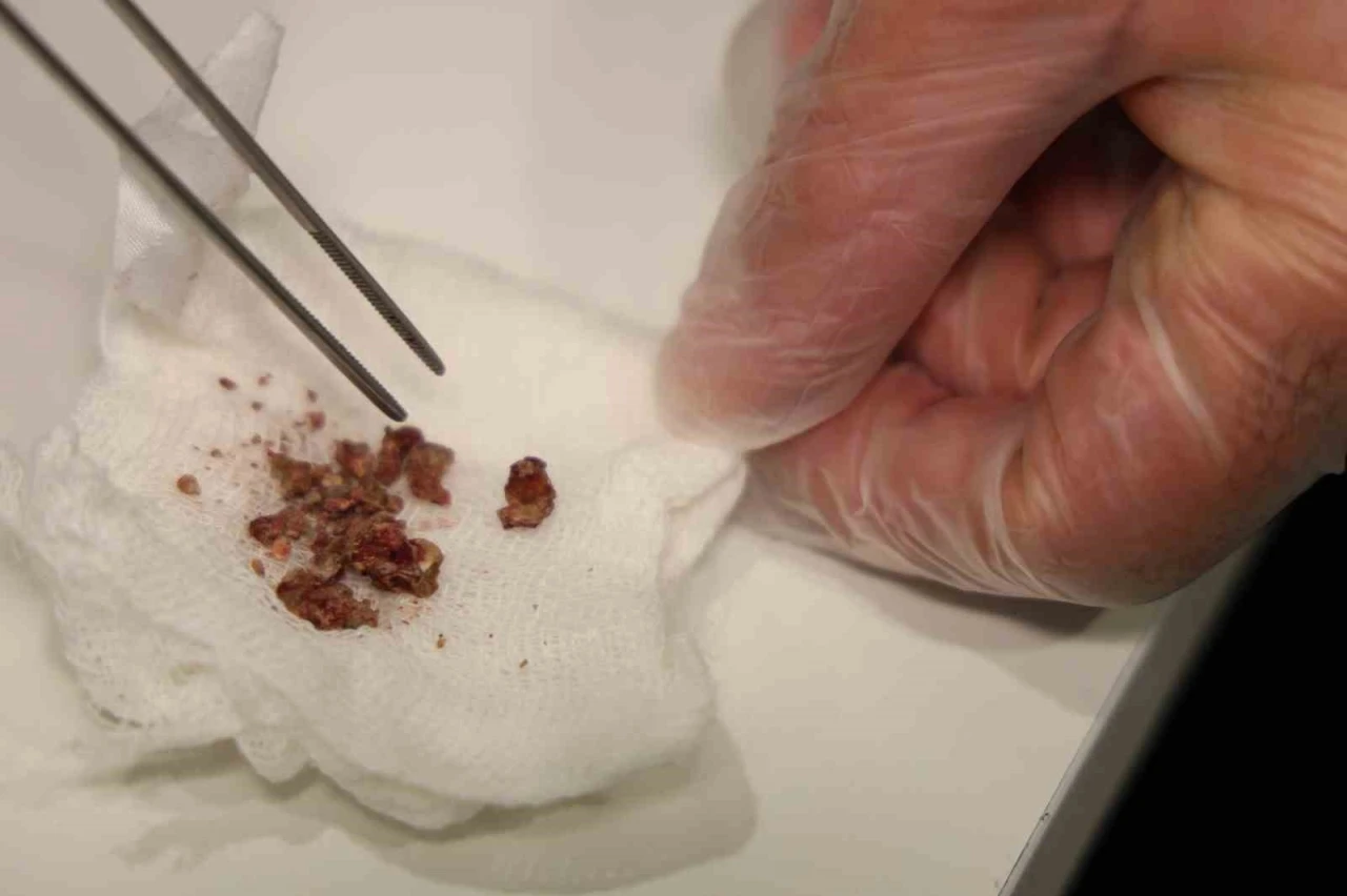 Elazığ&rsquo;da estetik ameliyatta şaşırtan olay, burundan taş &ccedil;ıktı
