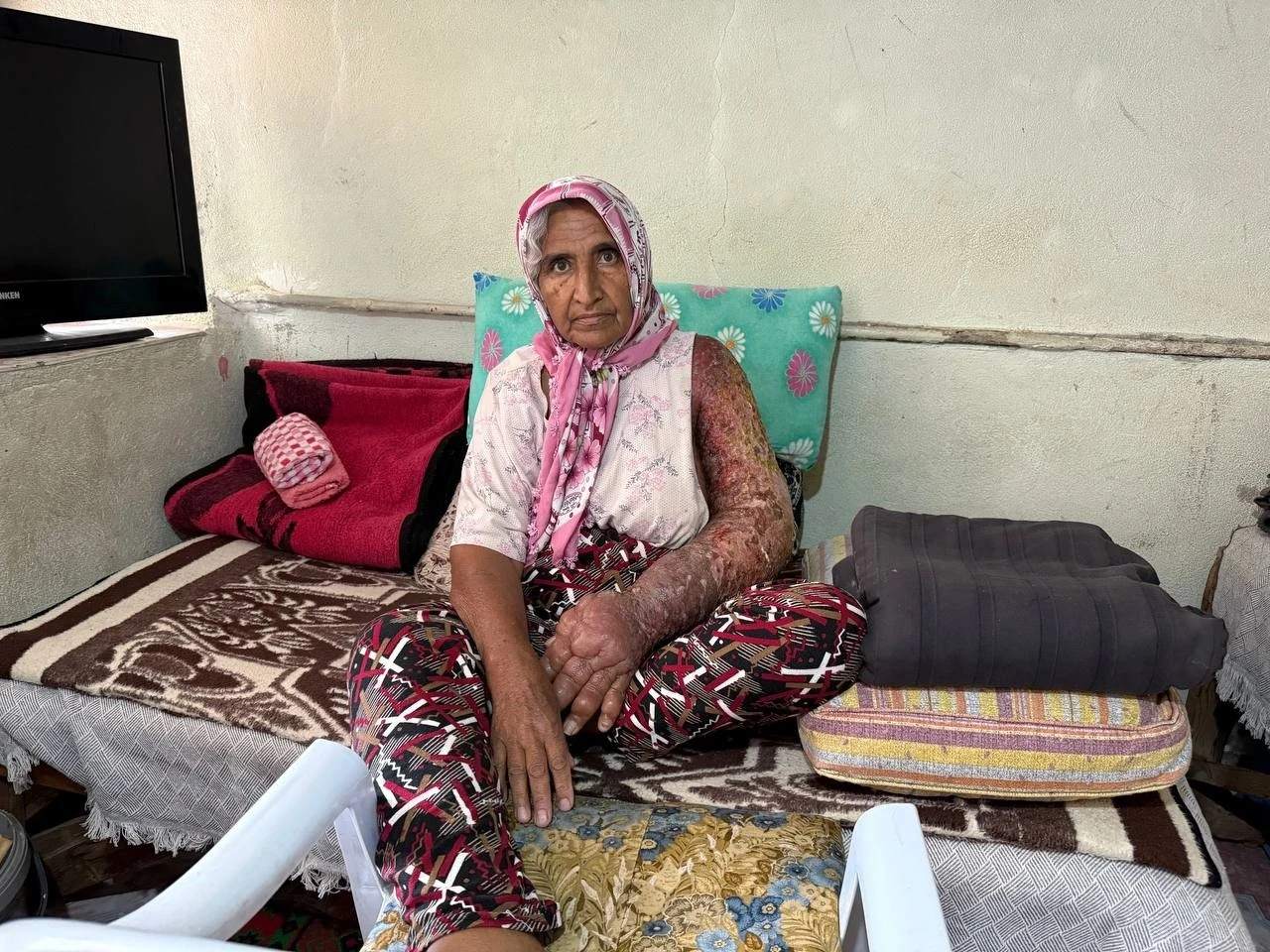 Kolu şişti, vücuduna kadar yara oldu: 4 çocuk annesinin zorlu yaşamı
