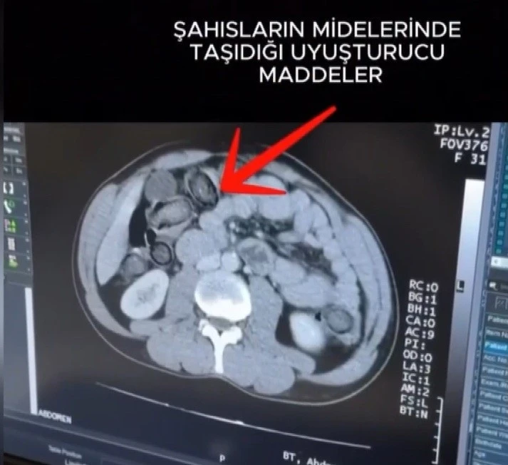 Mideye gizlenen uyuşturucu Erzincan&rsquo;da ele ge&ccedil;irildi
