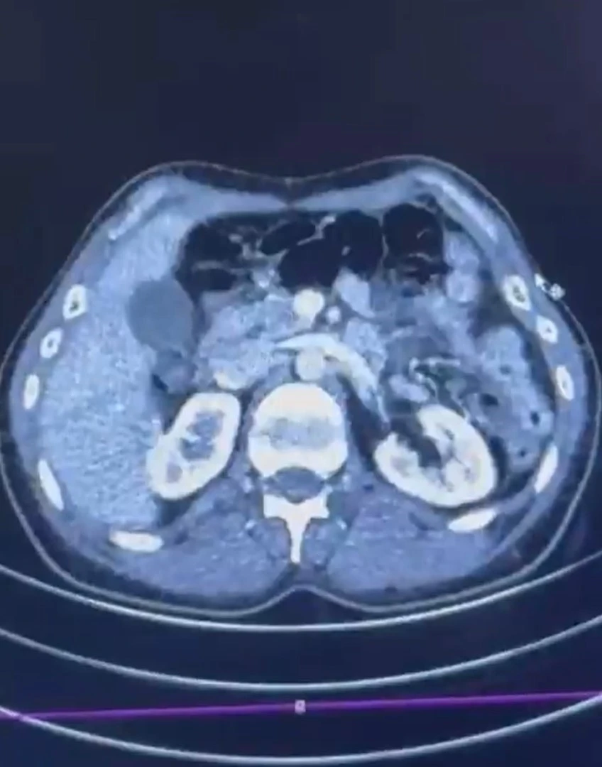 Ülkeye midelerinde uyuşturucu getiren şahıslar yakalandı
