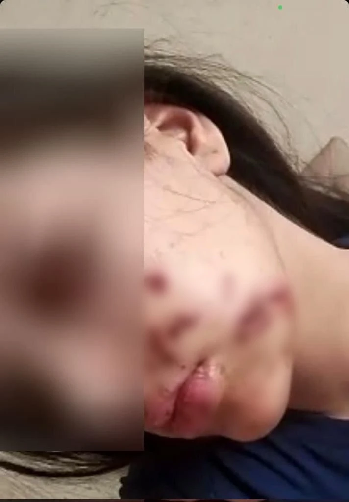 Yüzüne maytap isabet eden genç kız yaralandı
