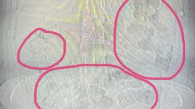 Midesinden uyuşturucu çıkan şahıs tutuklandı