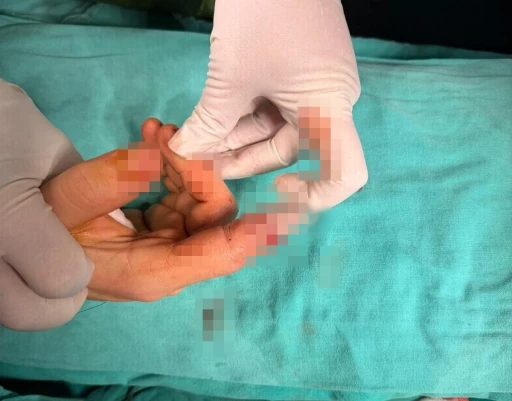 Bandırma&rsquo;da asans&ouml;r kazasında kopan parmak başarılı ameliyatla kurtarıldı
