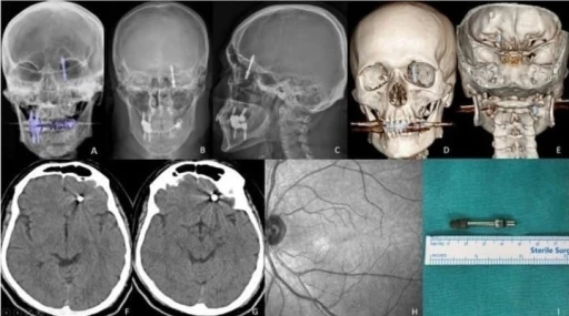 Beynine saplanan implant hayatını kararttı: 2 yıldır adalet bekliyor
