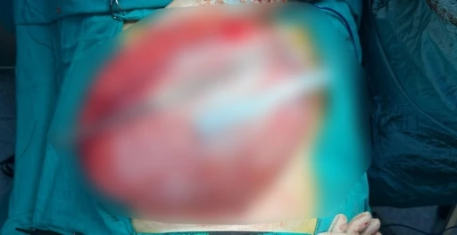 Kilo vermek i&ccedil;in hastaneye giden &ccedil;ocuğun karnından 3,5 kiloluk kist &ccedil;ıktı
